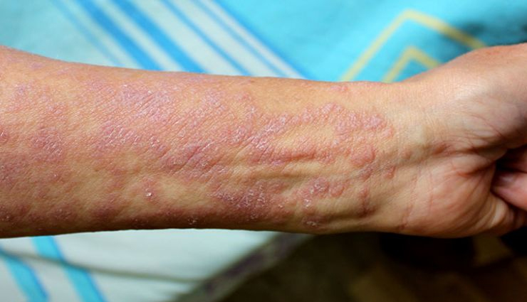 Most Common Causes Of Lichen Planus Lifeberrys