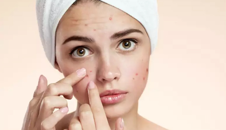 7 Magical Remedies To Help You Get Rid Of Acne - Lifeberrys.com