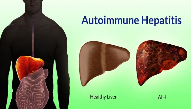 विश्व हेपेटाइटिस दिवस : ऑटोइम्यून हैपेटाइटिस के लक्षण और इलाज