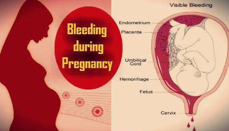 Any Kind Of Bleeding During Pregnancy Needs Attention Lifeberrys