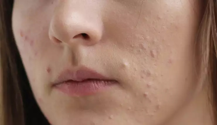 How To Get Rid Of A Blind Pimple Under The Skin 10 Remedies Prevention Tips