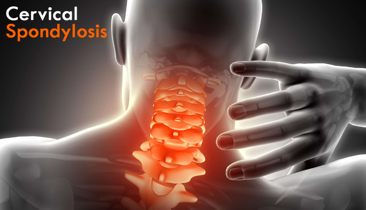 11 Remedies That are Useful for Cervical Spondylosis - lifeberrys.com