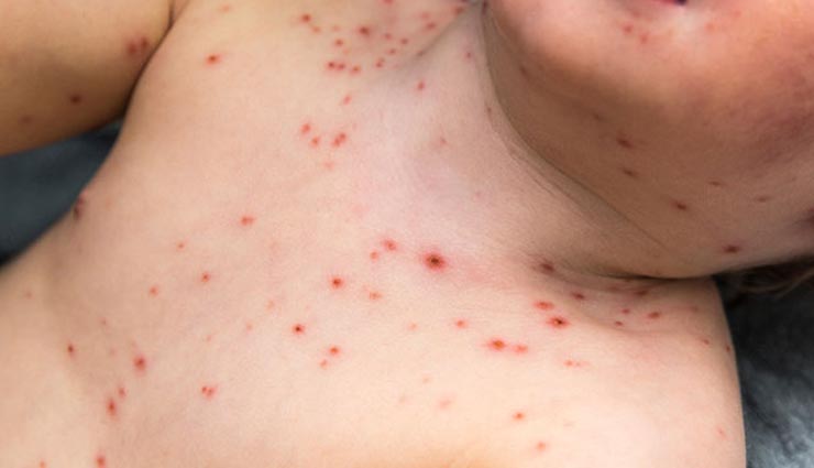 chicken pox,remedy for chicken pox ,छोटी माता,चिकन पॉक्स