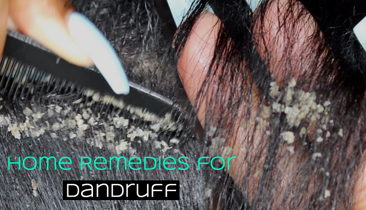 5 Easy Home Remedies To treat Dandruff Problem - lifeberrys.com