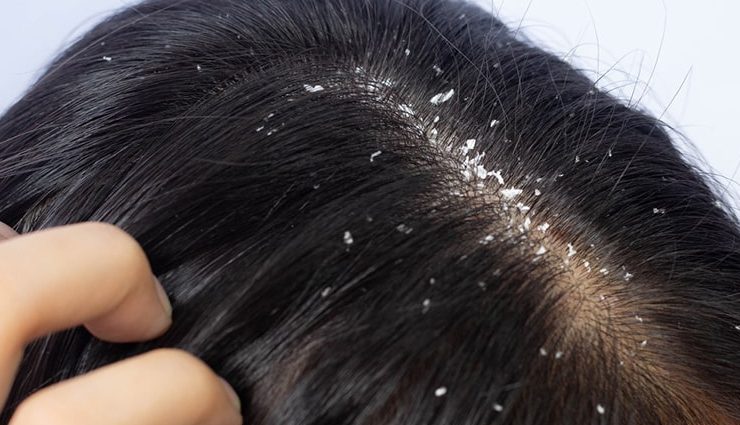 How To Treat Scabs On The Scalp - lifeberrys.com