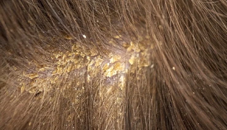 hot oil hair mistake,hair care tips,hair damage prevention,hot oil hair risks,hair health warning,common hair care mistakes,hair damage causes,safe hair care practices,hot oil treatment risks,hair damage signs