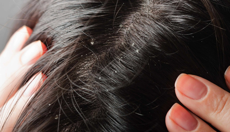 6 Natural Ways To Help You Get Rid of Dandruff - lifeberrys.com