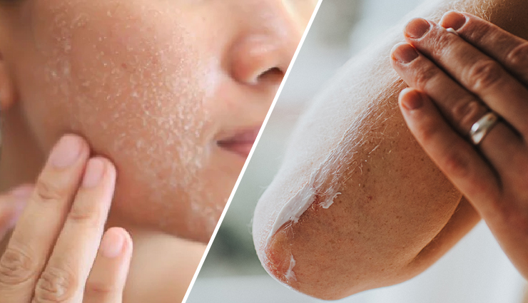 5 Ingredients That Will Keep Your Dry Skin Soft During Winters