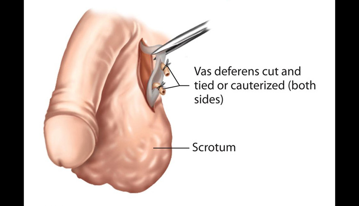 पुरुष नसबंदी से जन्मदर होती है नियंत्रित, जानें सेक्स लाइफ पर कैसा पड़ता है प्रभाव 