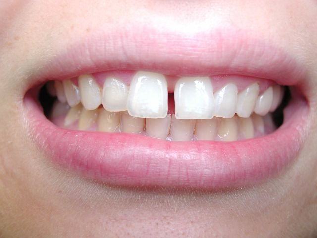 nature of person,gap between front teeth,astrology tips ,दांतों के बीच गैप,व्यक्ति के बारे में