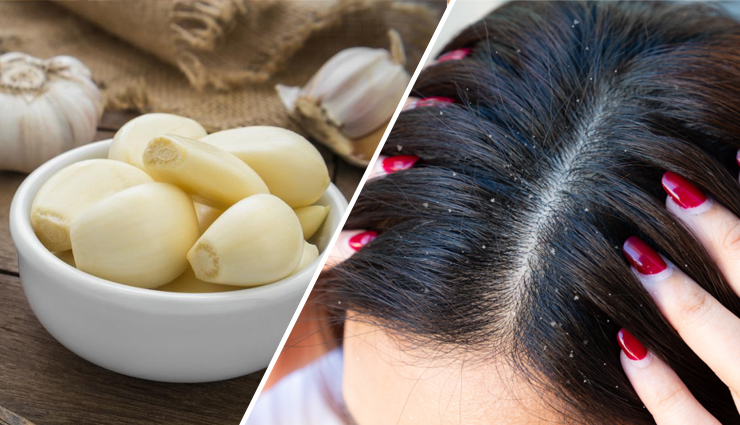 5 DIY Garlic Hair Masks To Treat Dandruff - lifeberrys.com