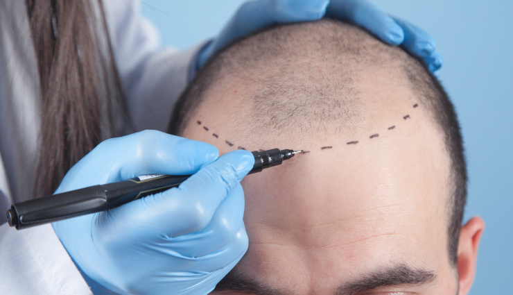 Preparing For A Hair Transplant Tips For A Smooth And Successful