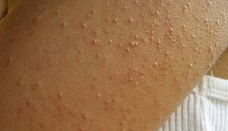 6 Reasons That Might Cause White Spots on Your Skin - lifeberrys.com