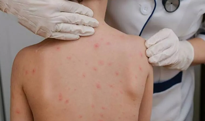 measles is spreading rapidly in children know its symptoms and necessary measures,Health,healthy living