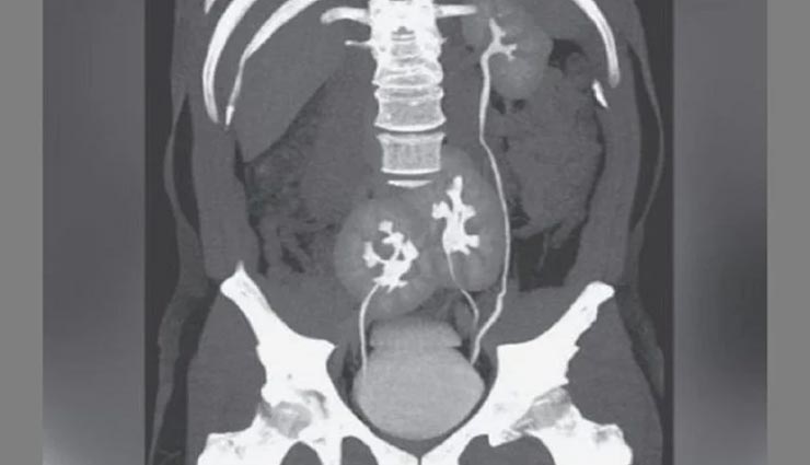 weird news,weird incident,three kidney in man ,अनोख खबर, अनोखा मामला, व्यक्ति के तीन किडनी