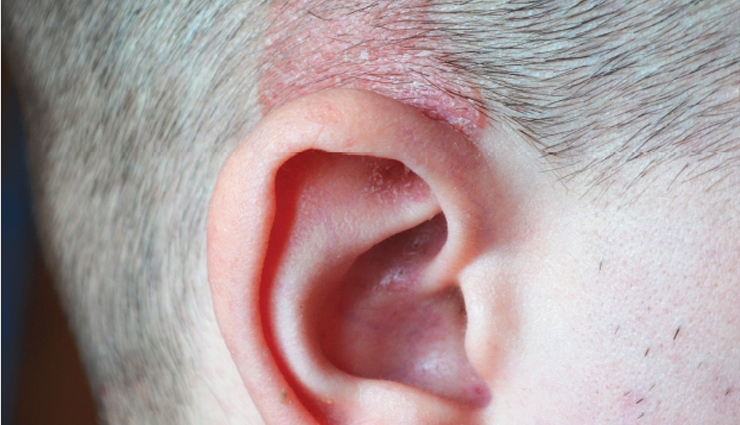 How To Treat Scabs On The Scalp