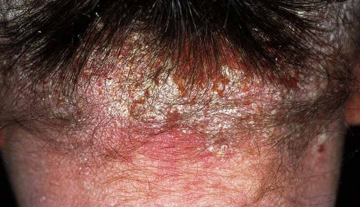 How To Treat Scabs On The Scalp 