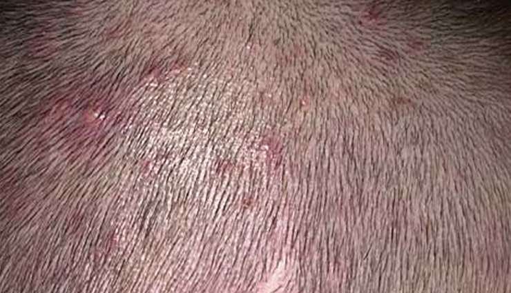 How To Treat Scabs On The Scalp - lifeberrys.com