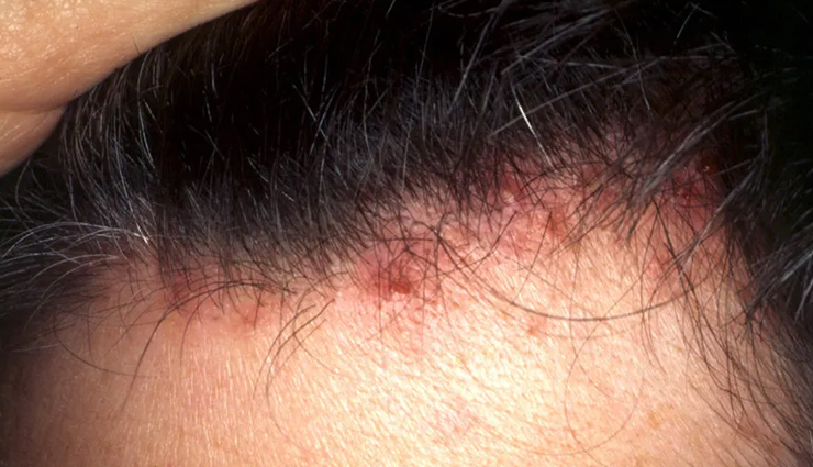 How To Treat Scabs On The Scalp - Lifeberrys.com