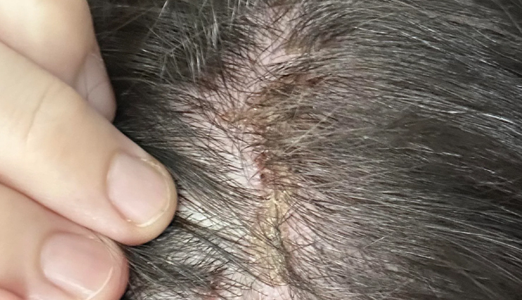 How To Treat Scabs On The Scalp 9685