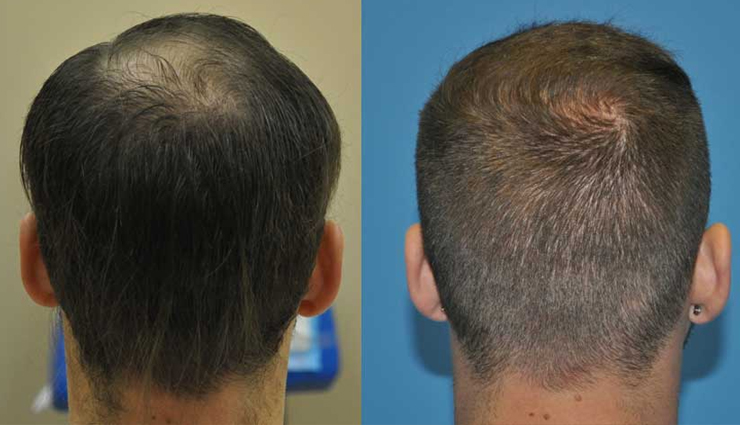 Everything You Need To Know About Stem Cell Therapy For Hair Baldness Lifeberrys Com