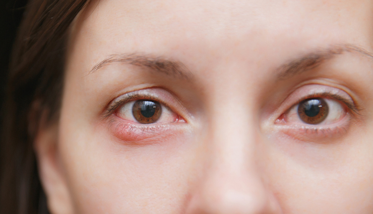 Here are Some Ways You Can Prevent and Get Rid of Styes in Your Eyes ...