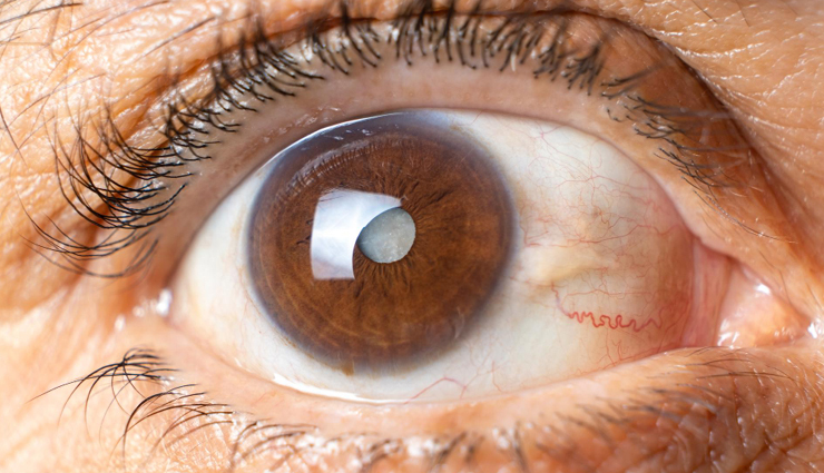 cataracts symptoms,cataracts causes,causes of cataracts,cataracts signs,cataracts risk factors,cataracts prevention