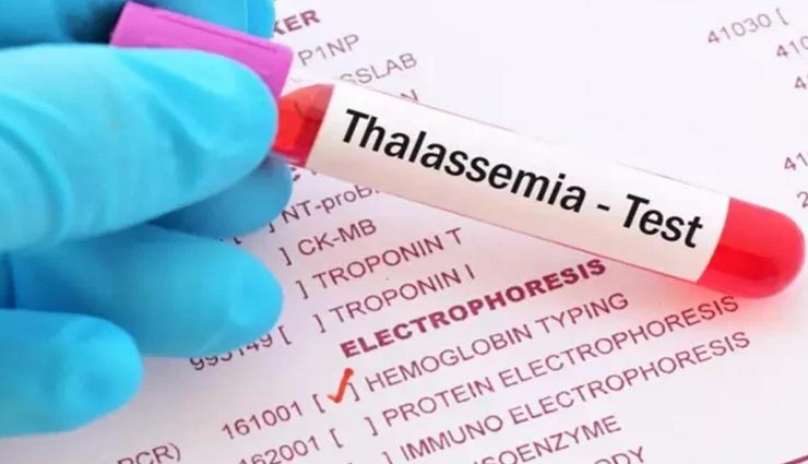 Health tips,health tips in hindi,world thalassemia day,symptoms and treatment ,हेल्थ टिप्स, हेल्थ टिप्स हिंदी में, वर्ल्ड थैलेसिमिया डे, थैलेसिमिया लक्षण और उपचार