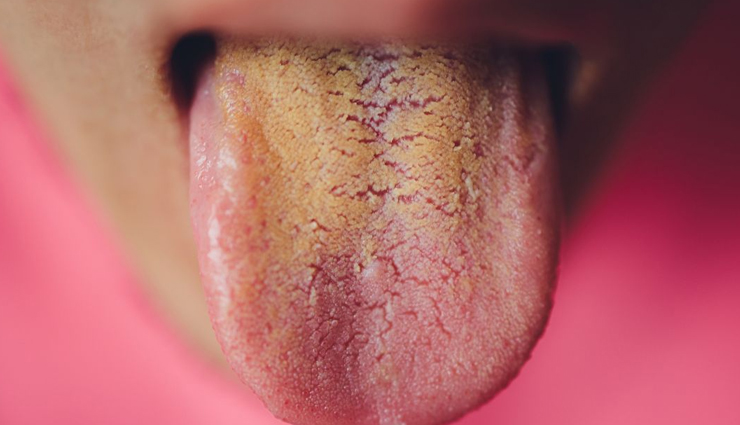 Here Is What The Color Of Your Tongue Say About Your Health ...