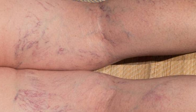 varicose veins causes,varicose veins symptoms,varicose veins treatment,preventing varicose veins,home remedies for varicose veins,varicose veins surgery options,varicose veins risk factors,varicose veins and pregnancy,natural treatments for varicose veins,varicose veins pain relief,varicose veins prevention tips,laser treatment for varicose veins,how to get rid of varicose veins,varicose veins in legs,varicose veins health risks