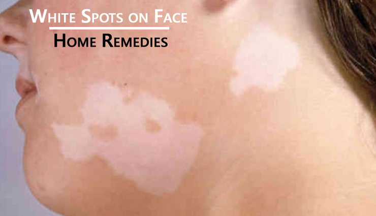 Home Remedies To Treat White Spots On Face Lifeberrys