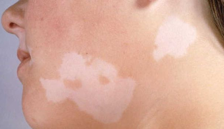 6 Reasons That Might Cause White Spots On Your Skin Lifeberrys