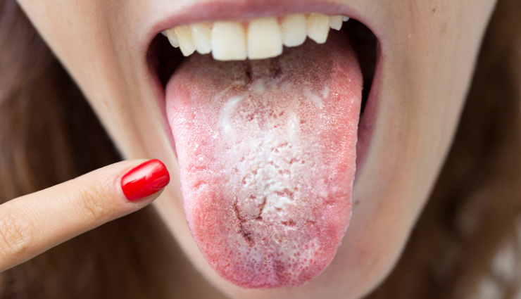 tongue color health,tongue color meanings,tongue health,white tongue causes,yellow tongue causes,red tongue meaning,blue tongue meaning,health signs from tongue color,tongue color and health,tongue color changes